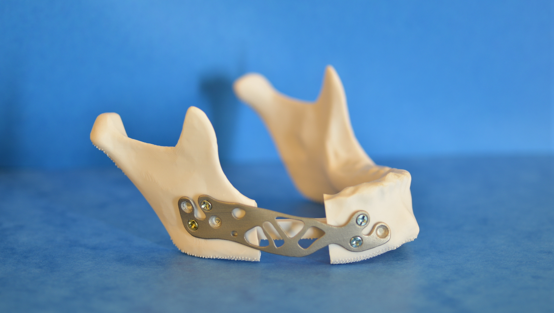 Glad 3D - Impression 3D de dispositifs médicaux